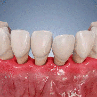 Advanced Targeted Gel for Periodontal Regeneration Treatment